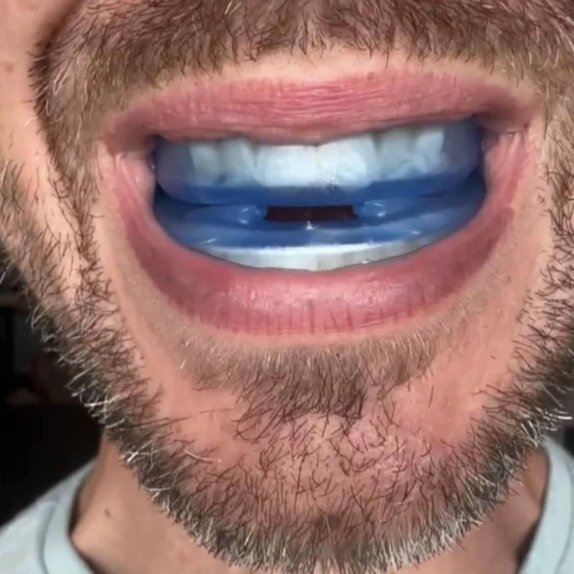 Protector Bucal Anti-Ronquidos